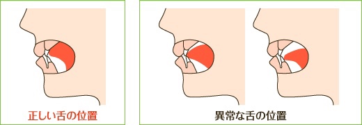 正しい舌の位置・異常な下の位置